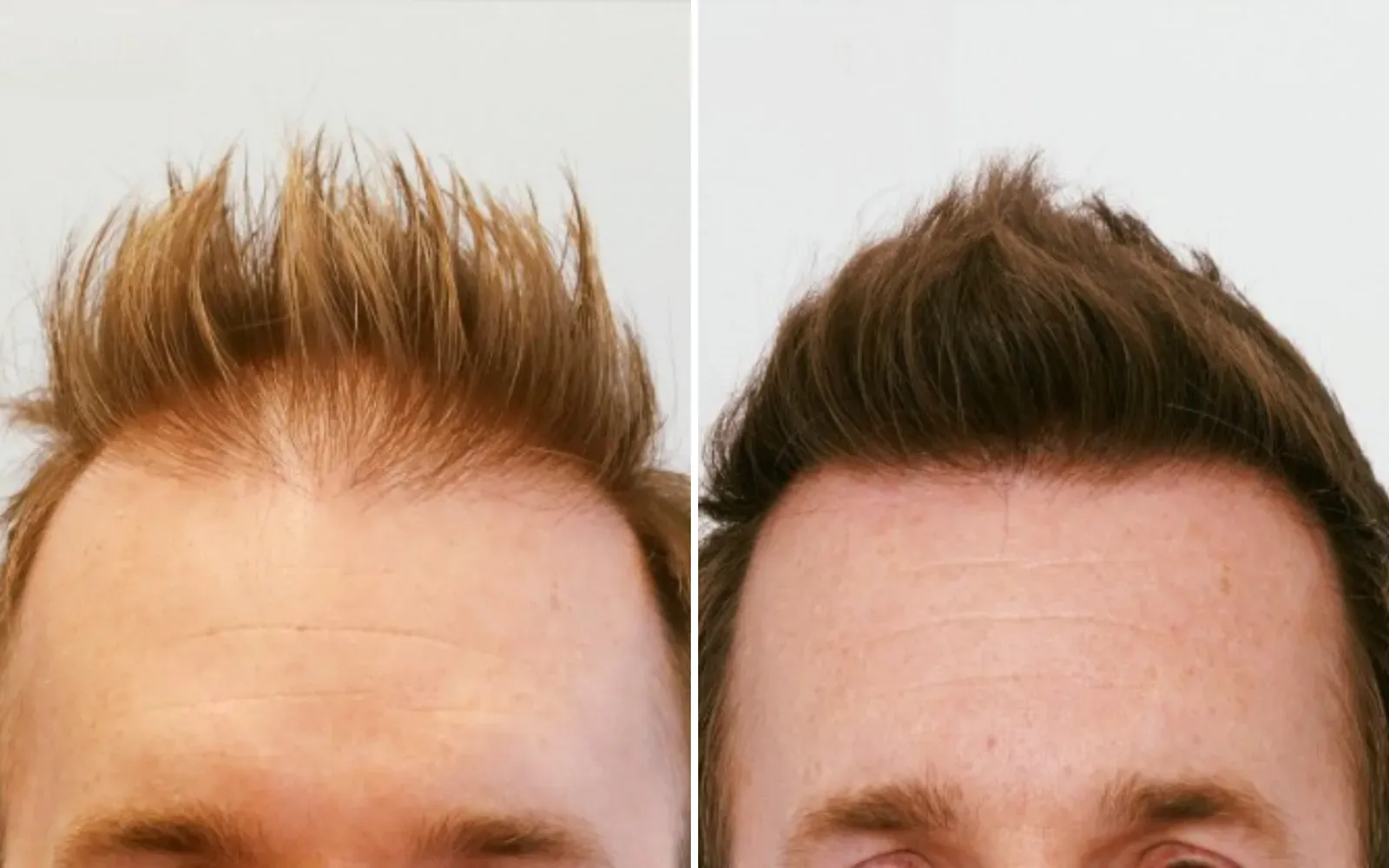 Guide to Hairline Restoration Options Near You